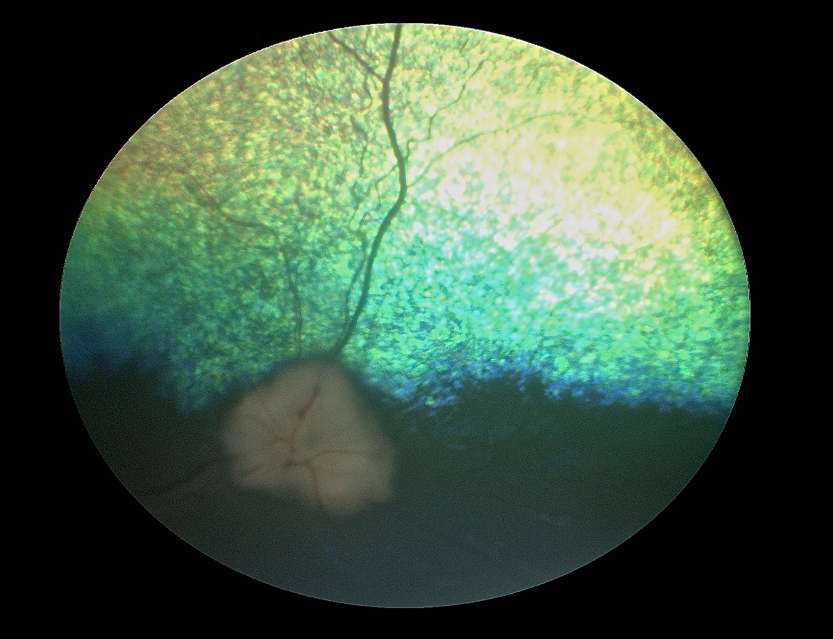 atrofia-progresiva-retina
