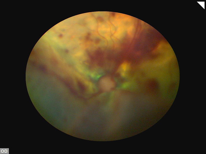 Desprendimiento de retina gato con hemorragias por hipertension