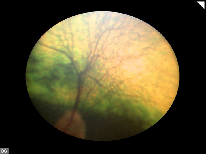 Retinografia fondo ojo caso glaucoma