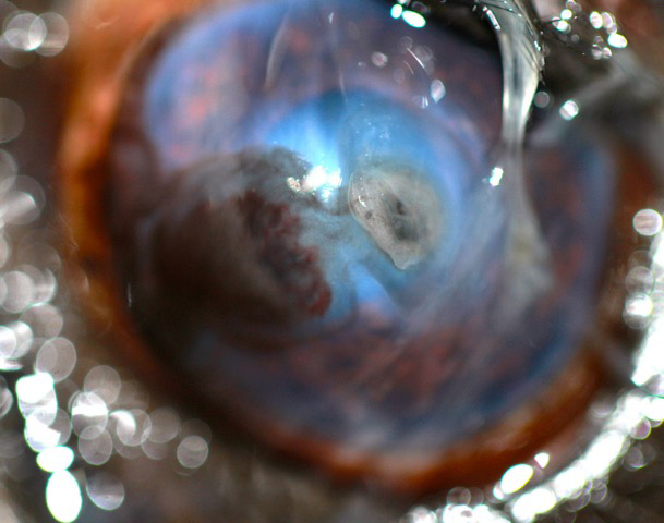 Perforación corneal y queratitis pigmentaria en el ojo izquierdo de Iker