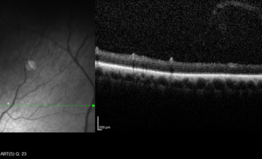 OCT de retina en perro - Caso luxacion cristalino Rio