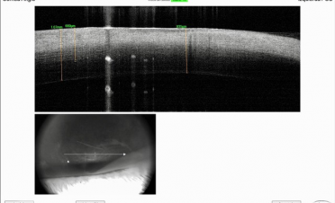 Tomografía de coherencia óptica (OCT) de gato con úlcera colagenasa - Caso Bagheera