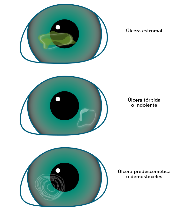 Tipos de úlcera corneal