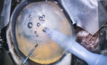 Cirugía de catarata con microscopio Artevo 3D