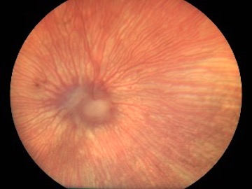 Desprendimiento de retina en gato a las 12 semanas de tratamiento