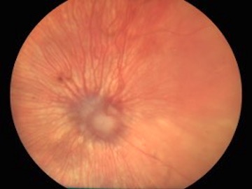 Desprendimiento de retina en gato a las 4 semanas de tratamiento