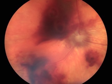 Desprendiimento de retina en gato a la 1a semana de tratamiento