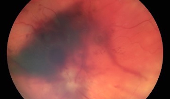 Retinografia ojo gato con desprendimiento de retina