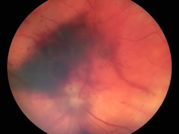 Retinografia ojo gato con desprendimiento de retina