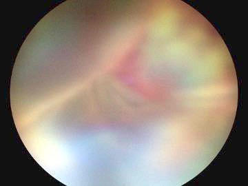 Retinografía de gato con desprendimiento de retina y hemorragia vítrea