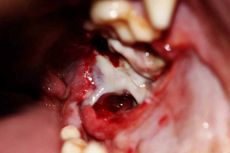 Absceso retrobulbar drenado en la cavidad oral de un perro, con evidencia de pus y tejido inflamado, mostrando el impacto de la infección en la zona afectada.