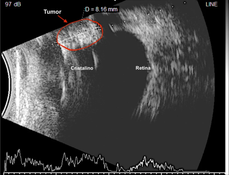 Ecografía ocular de Thor mostrando una masa intraocular de 8,16 mm invadiendo los cuerpos ciliares del globo ocular izquierdo. La imagen revela la extensión de la lesión en la parte posterior del ojo.