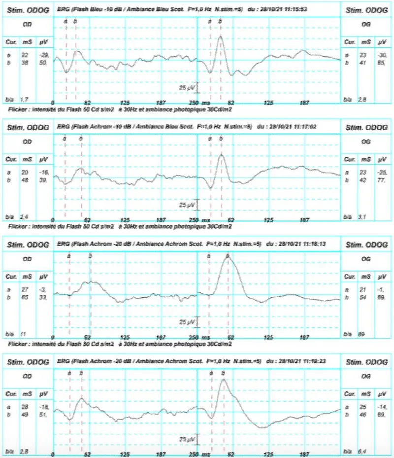 Gráficas de electrorretinografía en perro mostrando respuesta disminuida en el ojo derecho y normal en el izquierdo, en condiciones fotópicas y escotópicas.