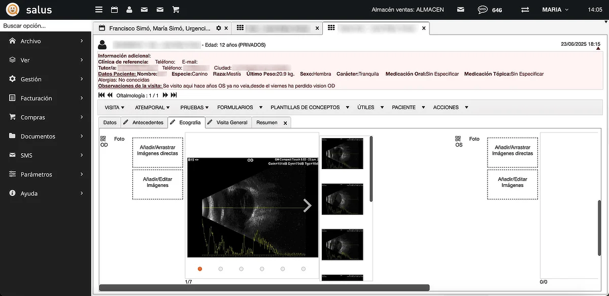 Imágenes de ecografía ocular en la ficha del paciente, dentro del programa Oftalmosalus utilizado en IVO.