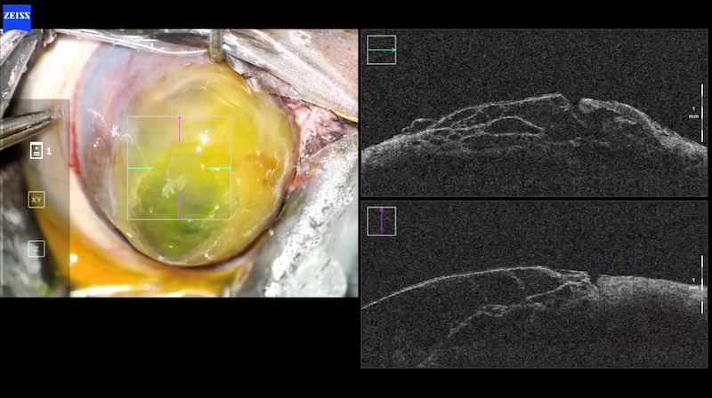 OCT intraquiúrgica o IOCT. 