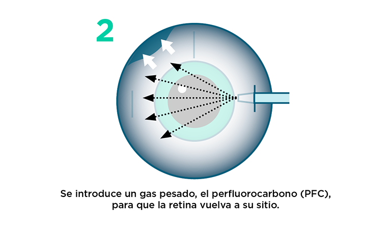 Vitrectomía: procedimiento paso 2