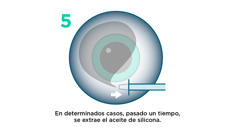 Vitrectomía: procedimiento paso 5