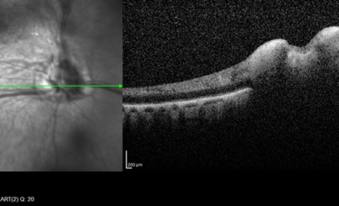 OCT del nervio óptico