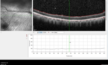 OCT Tomografia Coherencia Óptica - Retina normal