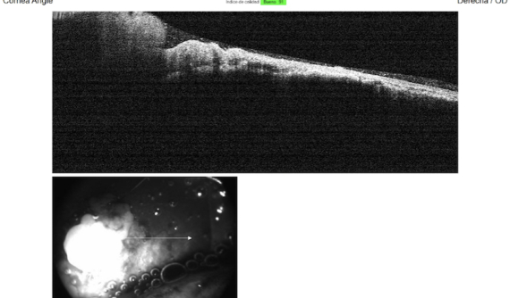 OCT de tumor corneal de perro Bulldog Inglés