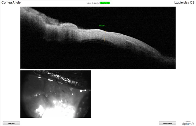 OCT caso perforación ocular revisión OCT caso perforación ocular revisión