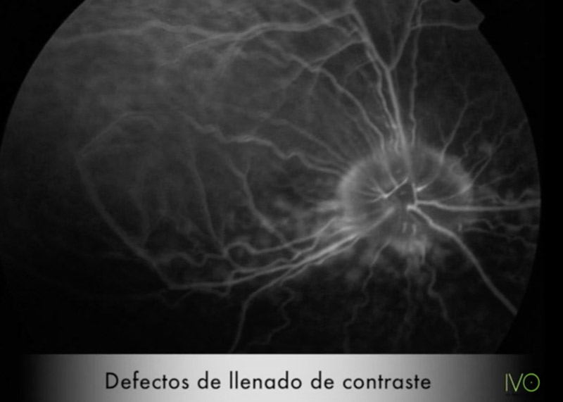 Angiografía fluoresceínica