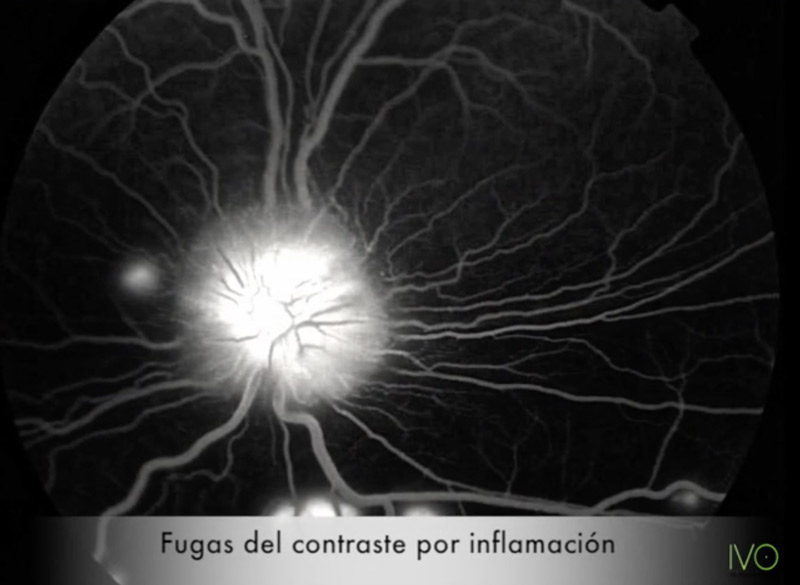Angiografía fluoresceínica