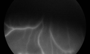 Angiografia perro - Caso luxacion cristalino Rio