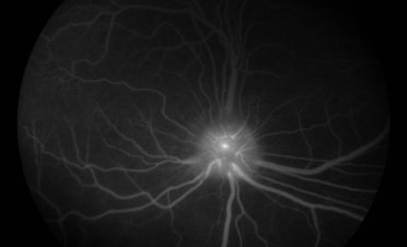 Angiografía perro - Caso luxacion cristalino Rio