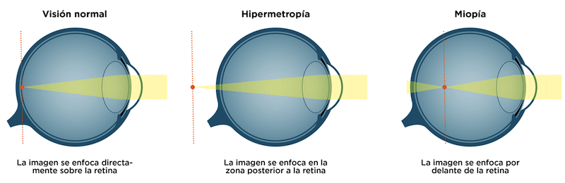 Miopía e hipermetropía en el caballo
