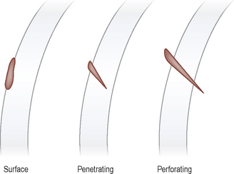 Cuerpo extraño en la córnea