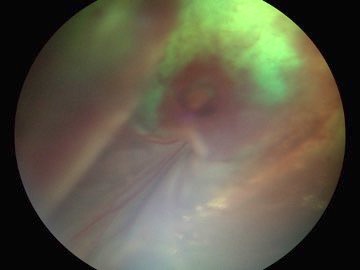 Desprendimiento de retina y hemorragia vítrea en gato a la 1a semana de tratamiento