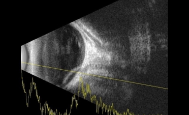 Ecografía perro con desprendimiento de retina - Caso Fox