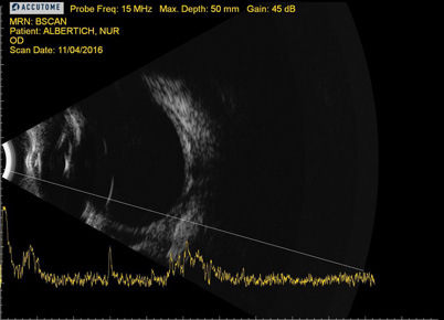 Queratitis-pannus-OD