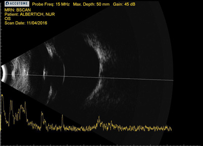 Queratitis pannus OS