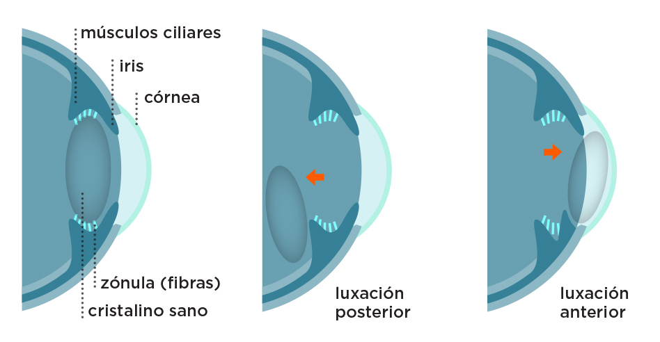 Esquema de luxación del cristalino