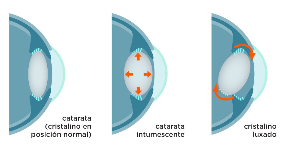Luxación del cristalino en catarata intumescente