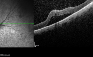 OCT Desprendimiento de retina