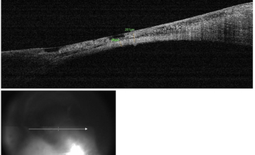 OCT de córnea en perro con úlcera corneal severa