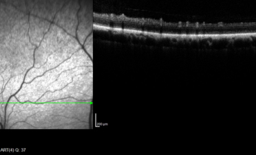 OCT de retina en perro - Caso luxacion cristalino Rio