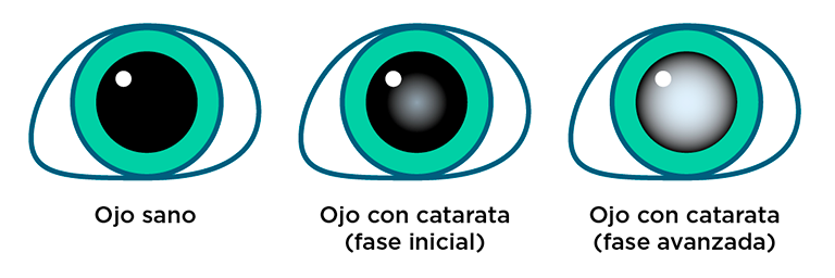 Ojo con cataratas - Fases de desarrollo