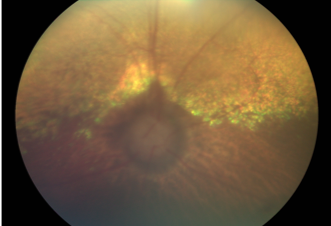 Ojo canino con glaucoma