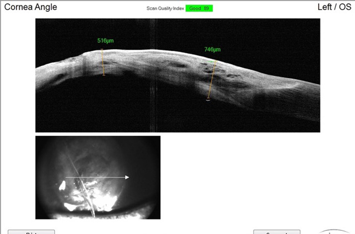 perforacion-corneal-OCT-Fiona