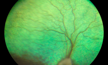 Retinografía perro - Caso luxacion cristalino Rio