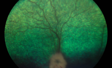 Retinografia perro - Caso luxacion cristalino Rio