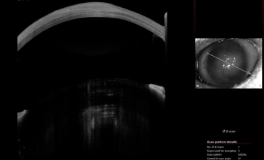 Tomografía de coherencia óptica (OCT) de gato con úlcera colagenasa