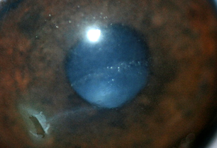 Ulcera corneal indolente